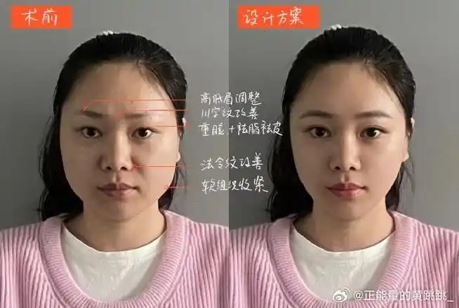 解决方案:78自体脂肪填充眉弓 眼窝 额头78首先,用自体脂肪克制的