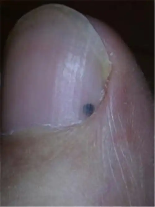 甲下良性黑色素瘤早期症状