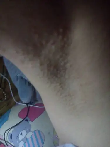 阴茎长毛囊炎的症状图片