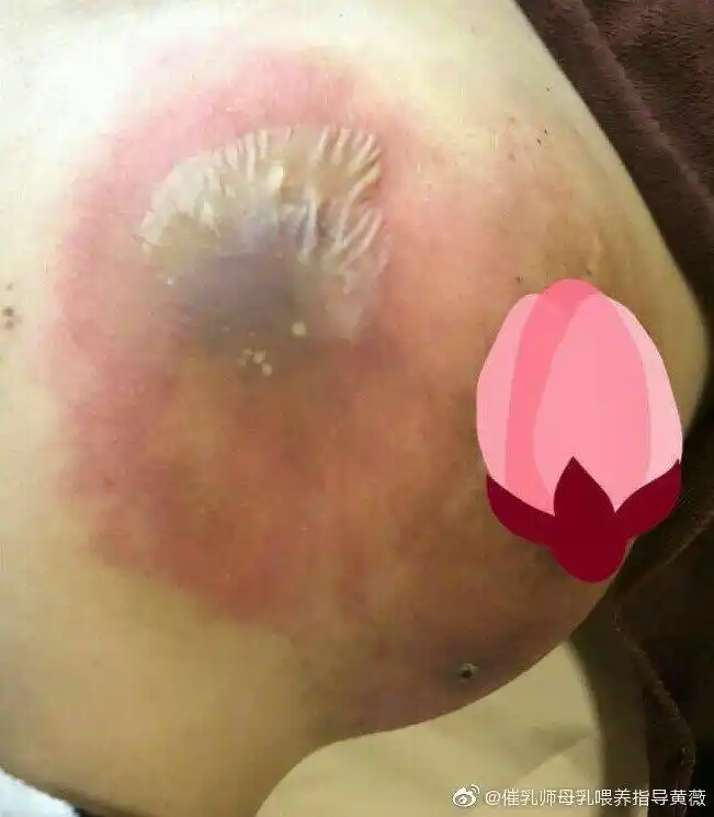 乳腺炎的三个阶段