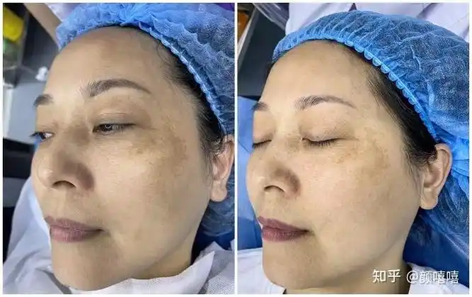 祛斑一定选皮秒,超皮秒!真人案例告诉你多有效!附价格表 - 知乎