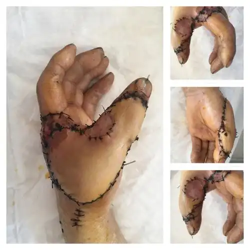 术后十一天,拆除荷包,植皮成活,皮瓣颜色红润,再造指成活.