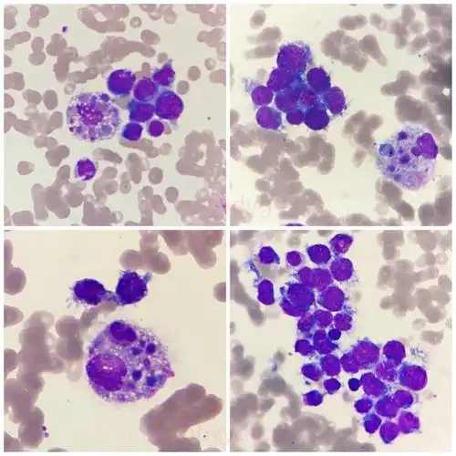 不安分守己的噬血细胞|红细胞|骨髓|白细胞|外周血|淋巴细胞_网易订阅