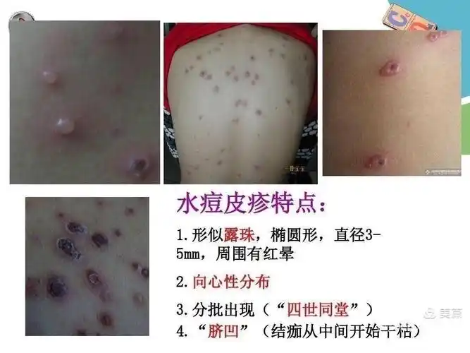 普及知识 预防为先——西柳木幼儿园水痘预防知识宣传