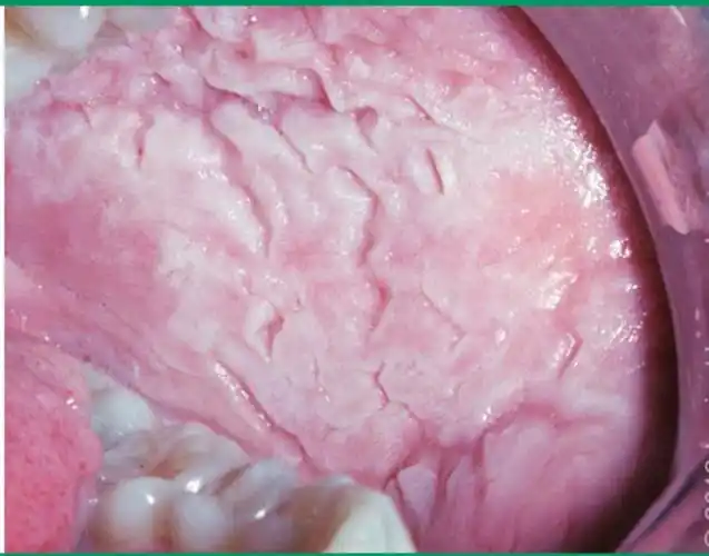 口腔黏膜长了斑,小心癌变!99%的风湿科医生都分辨不了!