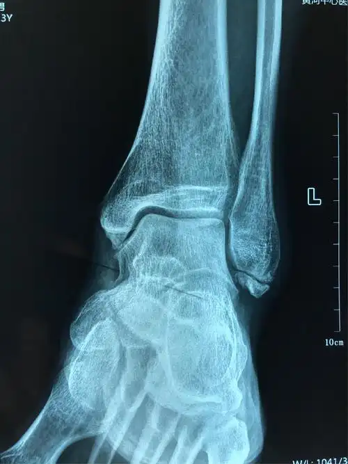 郑州市骨科医院足踝外科 王亚磊 左踝关节外侧副韧带损伤