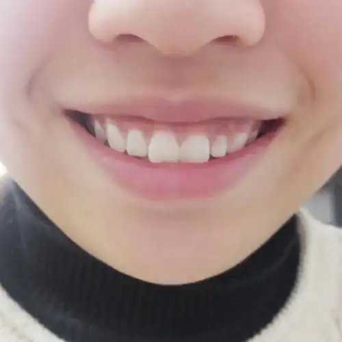 想问一下我的牙齿算正常吗?因为侧面看下巴有点内缩,下巴有点短