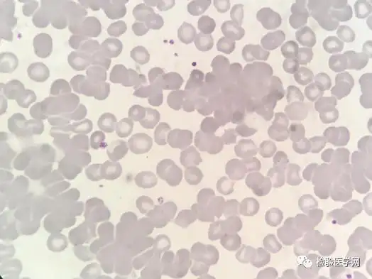 面对一份「高冷」的红细胞凝集标本,你会如何处理?