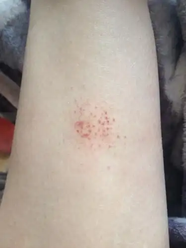 小腿上起的小红点,在皮肤下层,不疼不痒