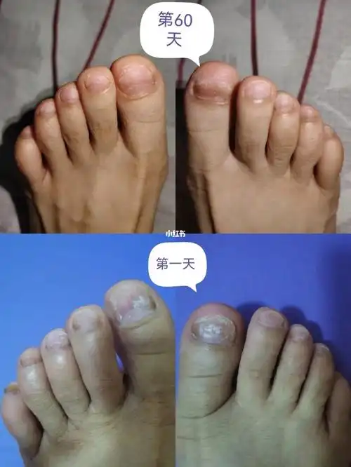 冰醋酸擦灰指甲第60天(两个月对比图)