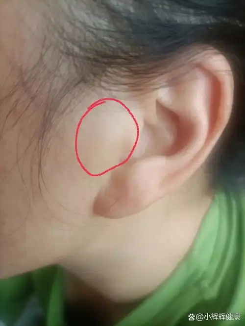 耳门这里有个包