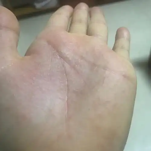 手心湿疹