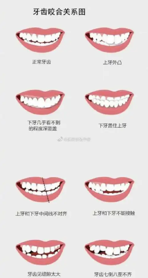 正常的咬合就是上,下颚的牙齿之间接触位置正确,并可以良好执行咀嚼