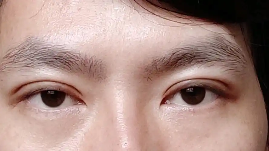 本人男,做的全切双眼皮手术,现在第12天了,看着太_圈子-新氧美容整形