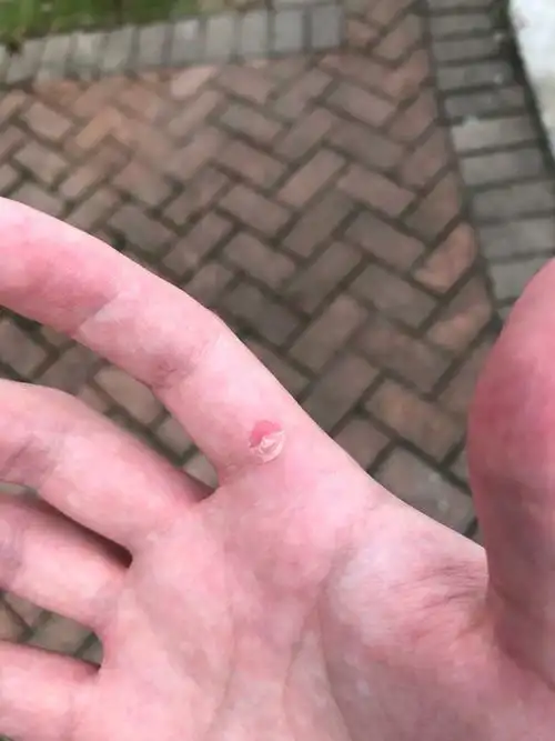 手破皮了,好几次了