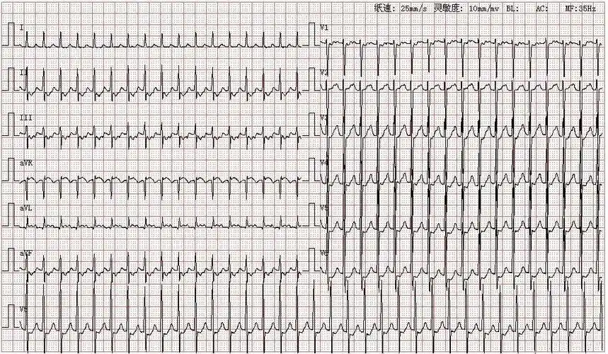 心电图图库丨室上性心动过速系列 - 知乎