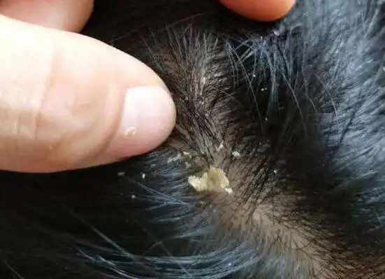 头皮屑多且大块还结痂