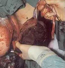 剖腹产现场实拍,胆小慎点!