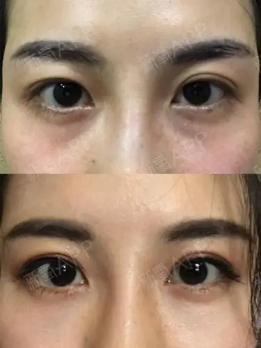 打完眼周胶原针两天,效果就已经很明显了,下面放了张_圈子-新氧美容