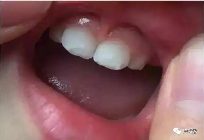 快仔细看看,你家宝宝乳牙也有这些问题吗?