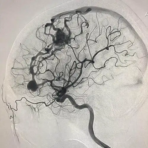 王雪梅,女,44,左侧脑血管畸形动脉瘤