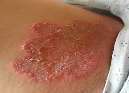 长沙鸿业皮肤医院:怎么判断是阴囊湿疹还是股癣?