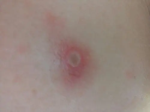 排完脓后伤口里面有一圈黑色的东西.这是什么啊?急!在线等!