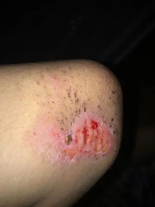 胳膊肘六天前摔破了,中间刮了个口子,进了不少沙粒,后来回去清洁了一