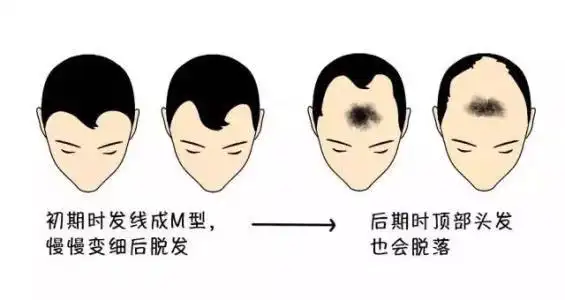 多效因子是如何治疗发际线后移的
