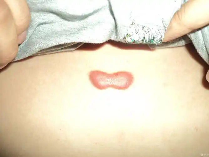 增生期的胸前瘢痕疙瘩能注射曲安奈德吗?效果怎么样?