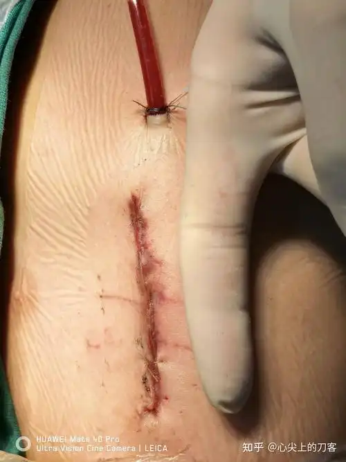 右侧腋下小切口微创手术治疗先天性心脏病