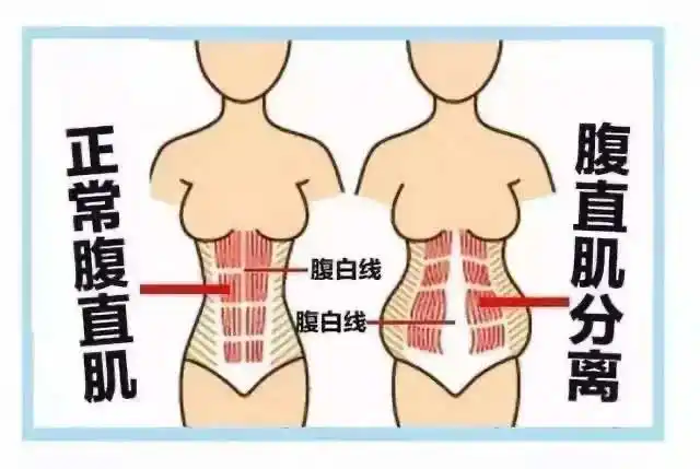 产后第三个做修复骨盆