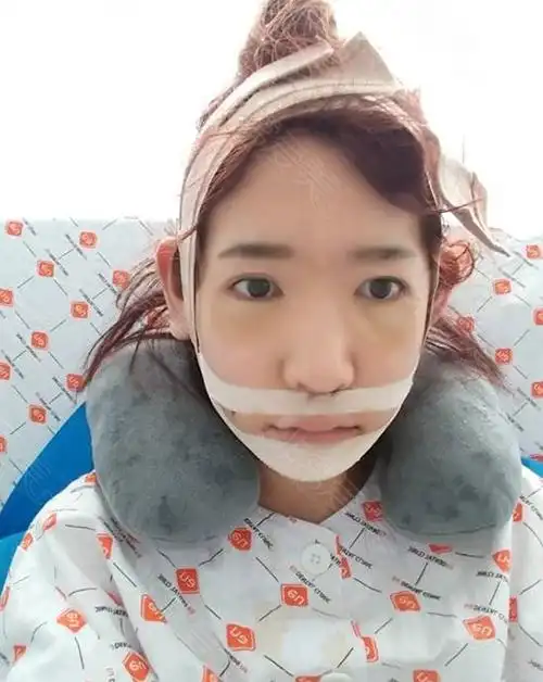 韩国eu整形外科长脸双鄂手术真人日记公开,术后效果超惊艳