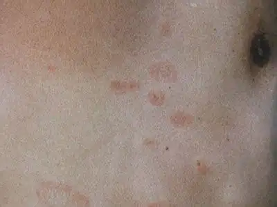 如何区分皮肤过敏和皮癣简述如何区分皮肤癣和过敏性皮炎