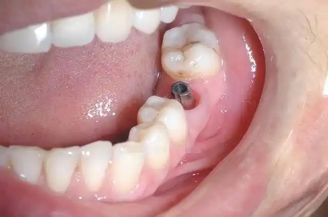 后悔拔掉烂牙根?这样的烂牙一样可以保留不拔