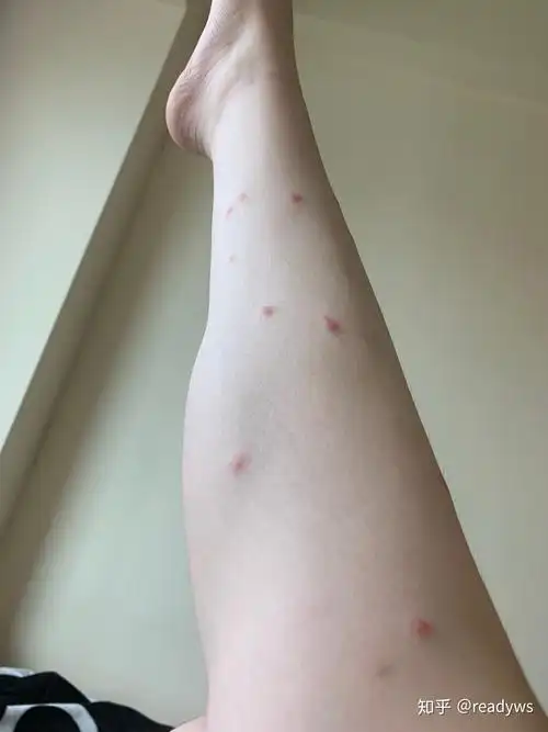 被跳蚤咬的全身都是包是什么样的感受