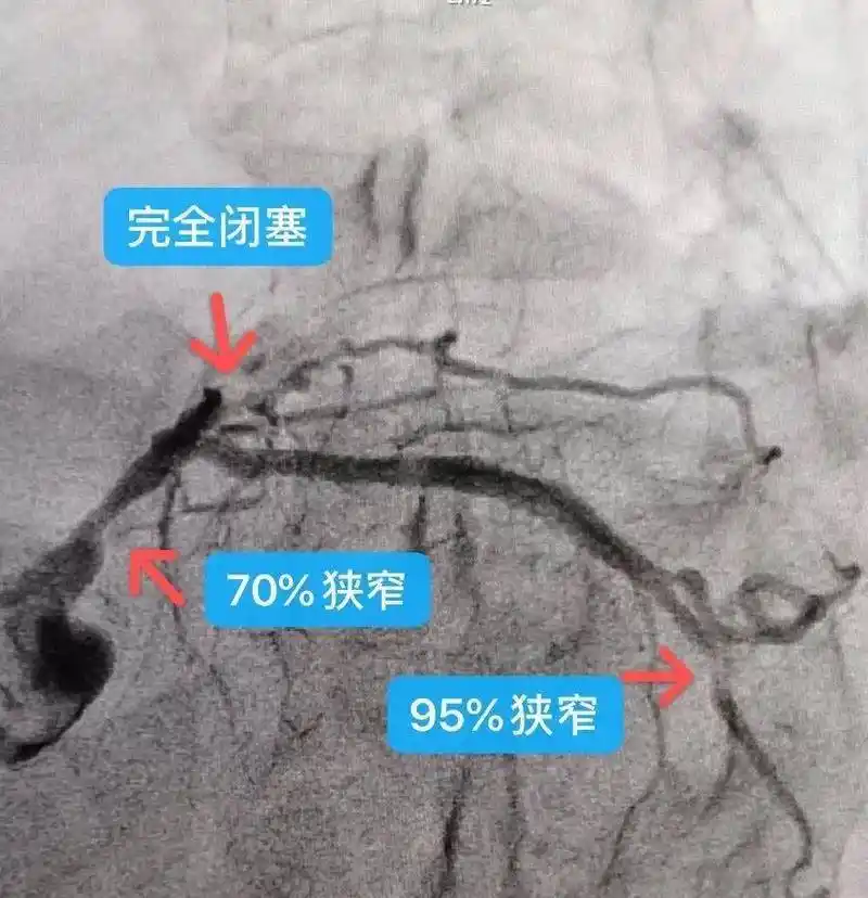 前因上述症状就诊于心血管病科,行冠脉造影检查提示三支血管重度病变