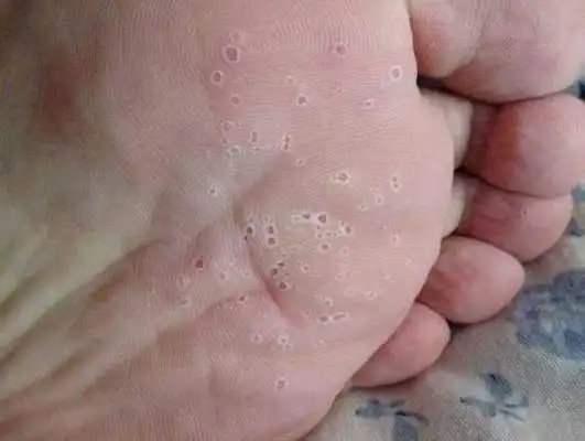 足藓初期症状图片9