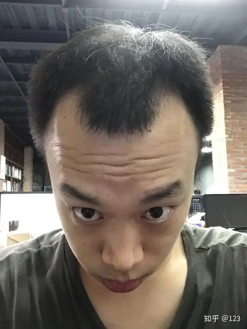 科发源二次植发