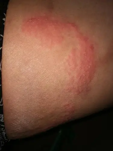 在腹股沟位置,以前好像有股藓,有点痒,一直也没去治疗过!