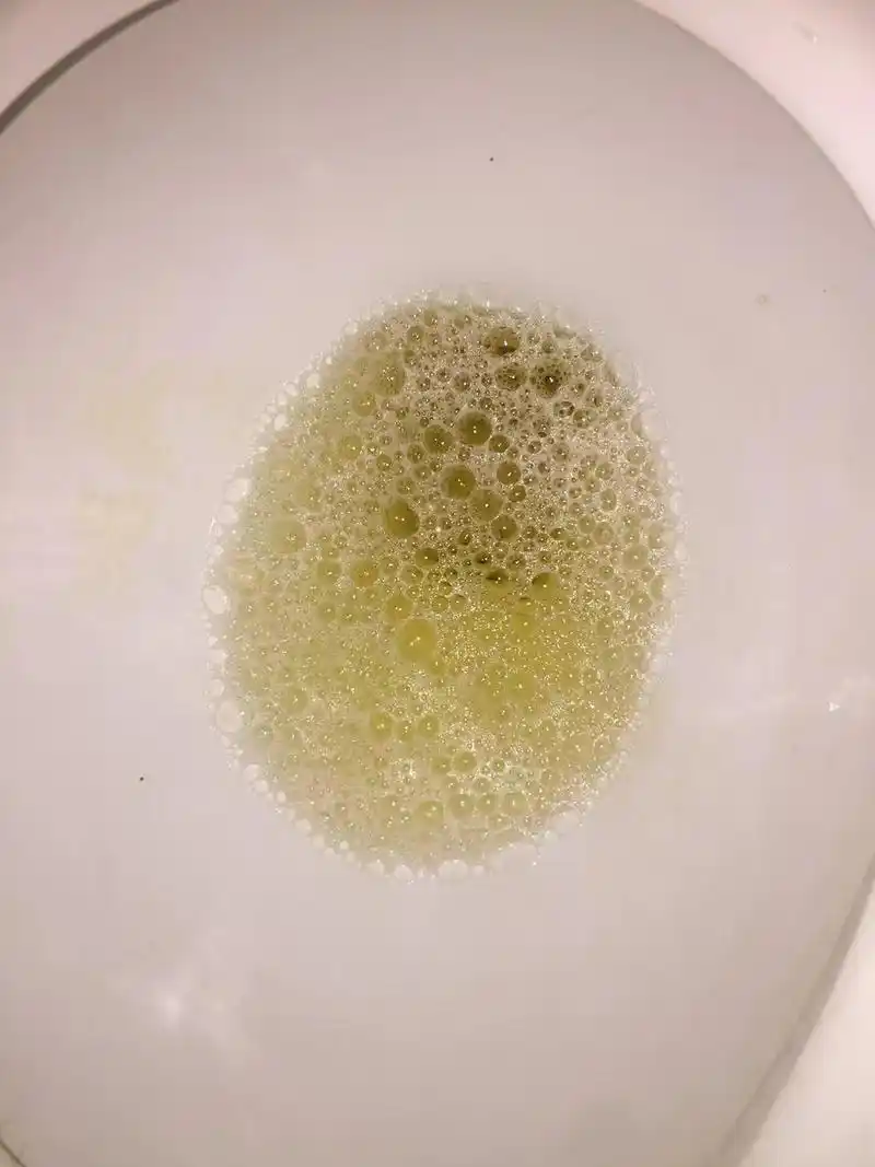 40岁的余女士,以浮肿,腰痛,泡沫尿2年余为主诉来诊.