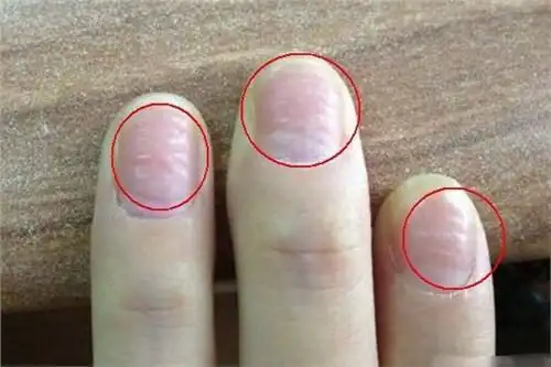 肝不好全写在指甲上这些变化是肝脏在求救再不重视就晚啦