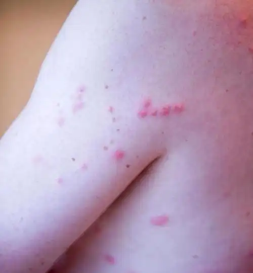 满虫咬皮肤是什么样子求图,螨虫咬的包是啥样子图片(就能知道自己是被