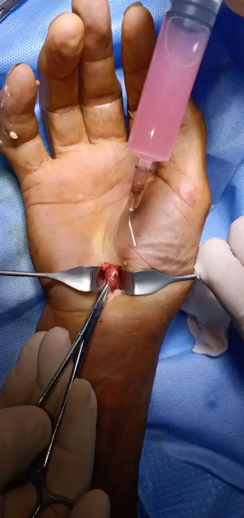 痛风性腕管综合症