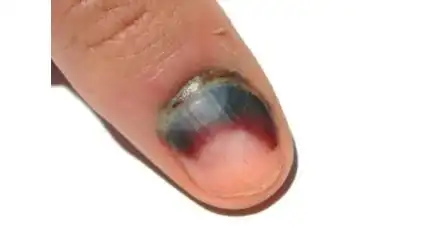 甲下血肿回顾已发表的8例色素性甲母质瘤病例,发现3例患者曾有外伤