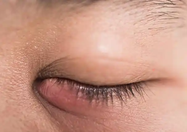 肾病眼皮肿图片肾不好眼睛浮肿的图片