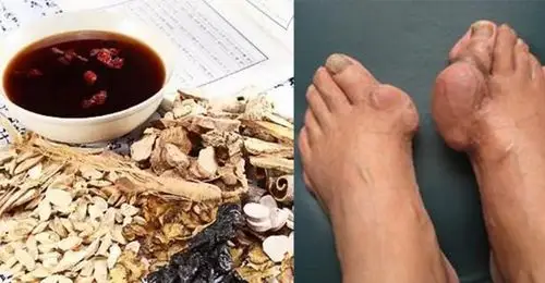 老中医超绝「痛风止痛方」,根治疼痛三帖见效,再也不用吞一堆止痛药了