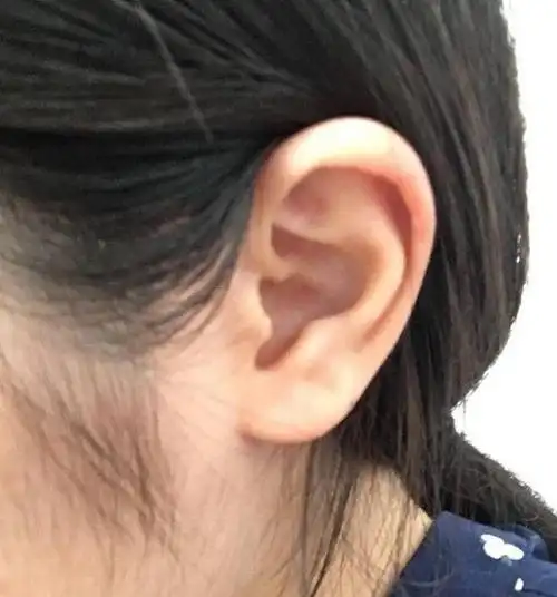 这个也是耳珠朝口的耳垂,说明生活事业都不错,内外耳齐平,夫妻恩爱