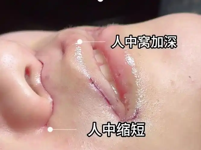 口周攻略|人中和人中窝能同时做吗