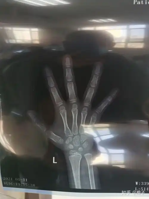 有没有医生帮我看一下,图片上的骨龄是多少钱的?未来身高有多高?